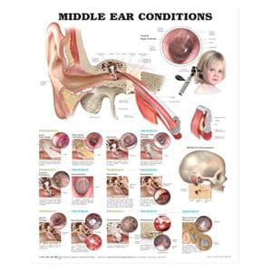 Middle Ear Conditions 20x26" Anatomical Chart Ea