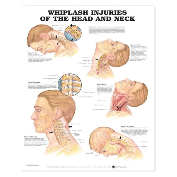 Whiplash Injuries Head/Neck 20x26" Educational Chart Ea
