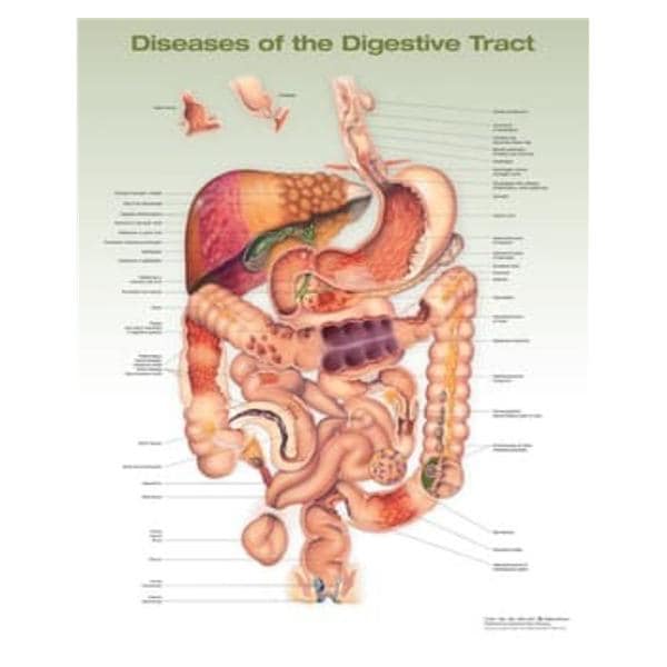 DISEASES OF THE DIGESTIVE TRACT 20x26" Anatomical Chart Ea