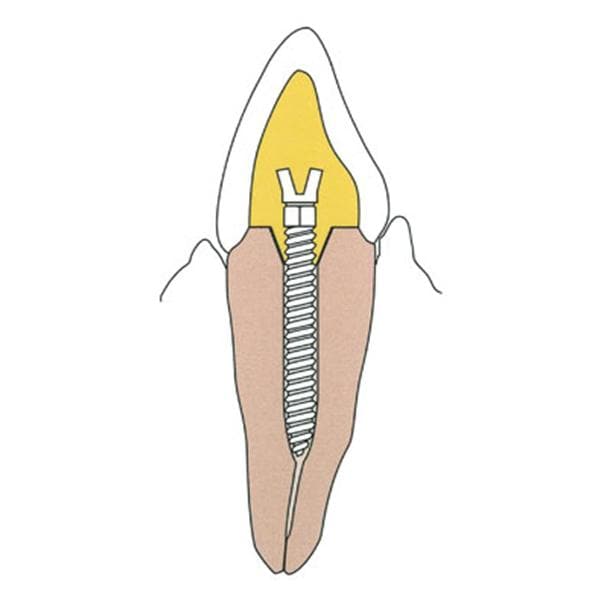 Surtex Posts Titanium 1.2 mm Parallel Sided & Tapered End 12/Bx
