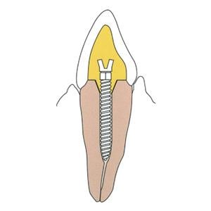 Surtex Posts Stainless Steel Size 1.2 mm Parallel Sided & Tapered End 12/Bx